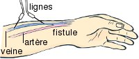 Fistule